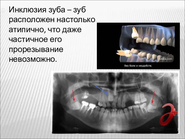 Инклюзия зуба – зуб расположен настолько атипично, что даже частичное его прорезывание невозможно.