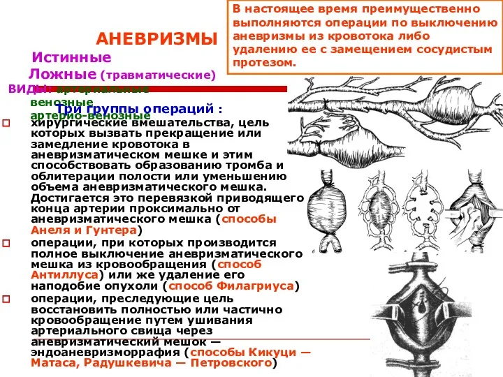 АНЕВРИЗМЫ Истинные Ложные (травматические) ВИДЫ: артериальные венозные артерио-венозные Три группы