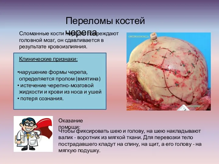 Переломы костей черепа Сломанные кости нередко повреждают головной мозг, он