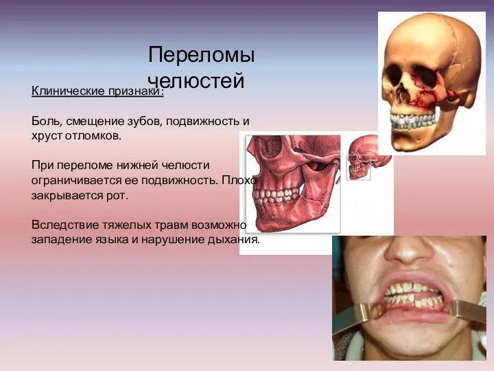 Переломы челюстей Клинические признаки: Боль, смещение зубов, подвижность и хруст