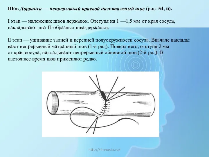 http://4anosia.ru/ Шов Дорранса — непрерывный кра­евой двухэтажный шов (рис. 54,