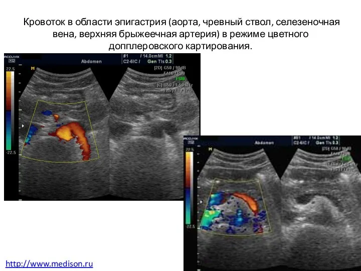 Кровоток в области эпигастрия (аорта, чревный ствол, селезеночная вена, верхняя