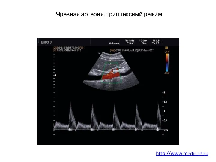 Чревная артерия, триплексный режим. http://www.medison.ru