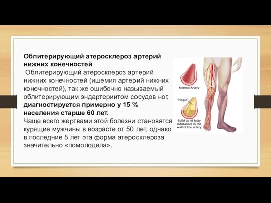 Облитерирующий атеросклероз артерий нижних конечностей Облитерирующий атеросклероз артерий нижних конечностей (ишемия артерий нижних
