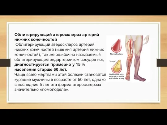 Облитерирующий атеросклероз артерий нижних конечностей Облитерирующий атеросклероз артерий нижних конечностей