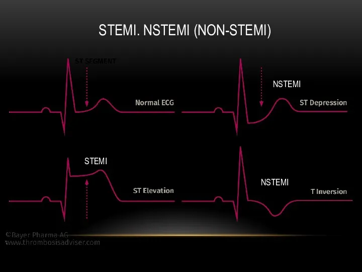 STEMI. NSTEMI (NON-STEMI) STEMI NSTEMI NSTEMI