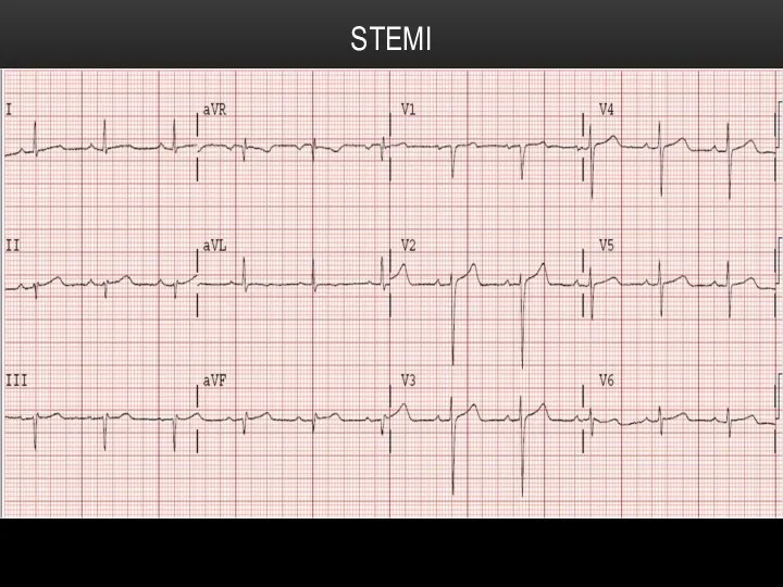 STEMI