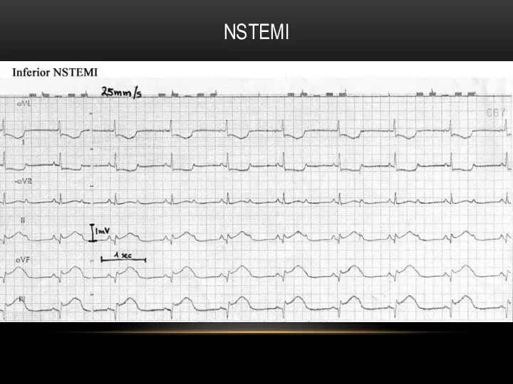 NSTEMI