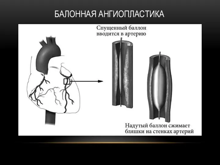 БАЛОННАЯ АНГИОПЛАСТИКА