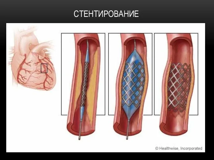 СТЕНТИРОВАНИЕ