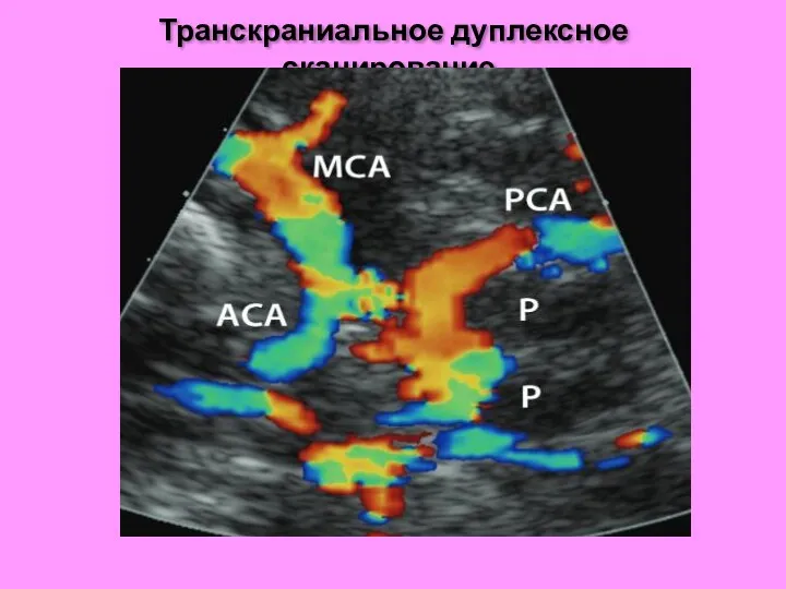 Транскраниальное дуплексное сканирование.