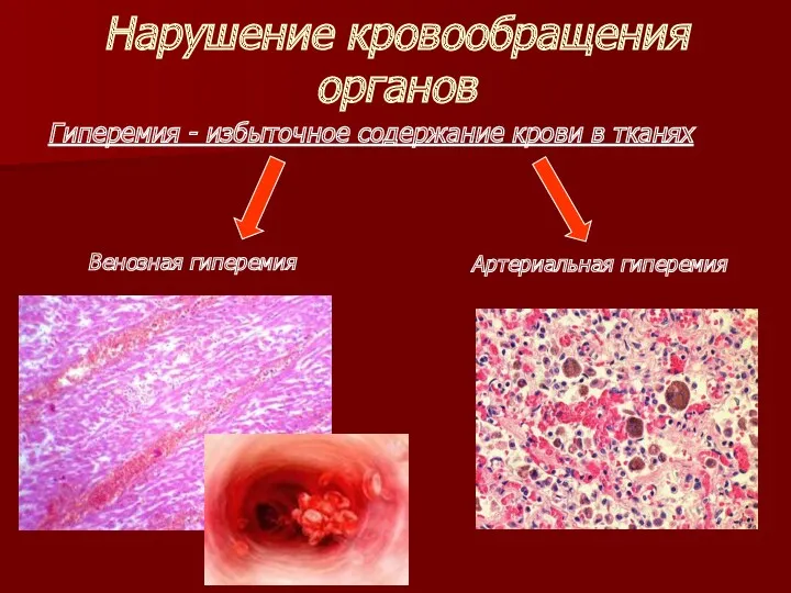 Нарушение кровообращения органов Гиперемия - избыточное содержание крови в тканях