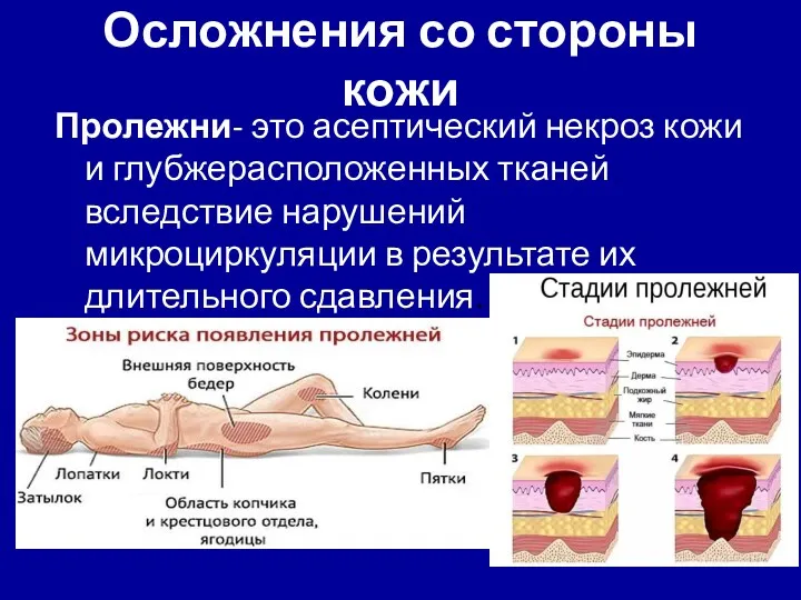 Осложнения со стороны кожи Пролежни- это асептический некроз кожи и