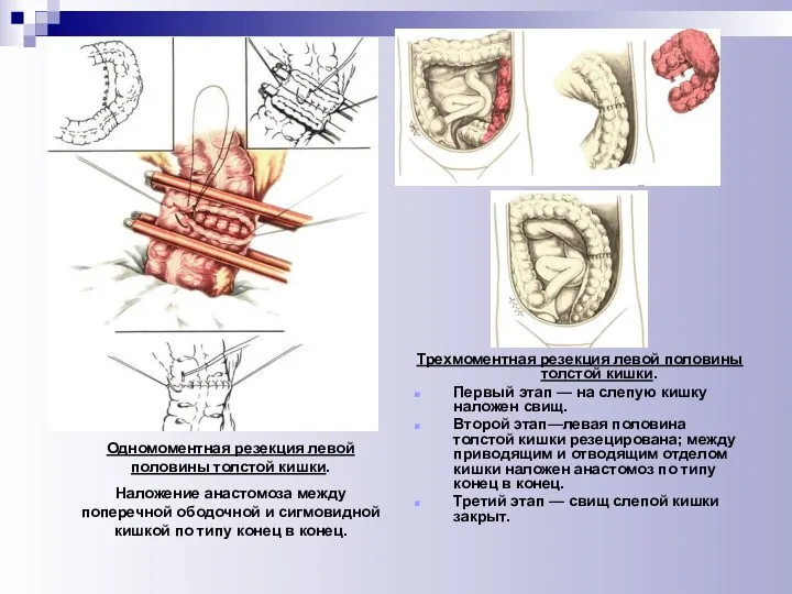 Одномоментная резекция левой половины толстой кишки. Наложение анастомоза между поперечной