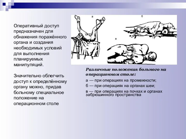 Различные положения больного на операционном столе: а — при операциях