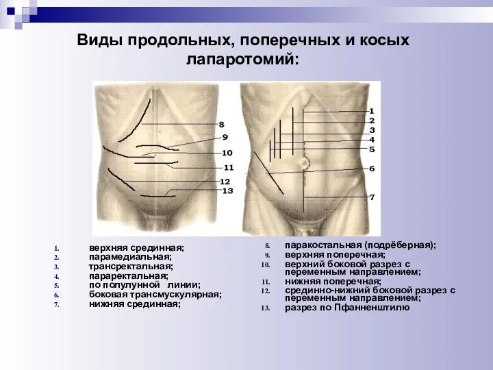 Виды продольных, поперечных и косых лапаротомий: верхняя срединная; парамедиальная; трансректальная;