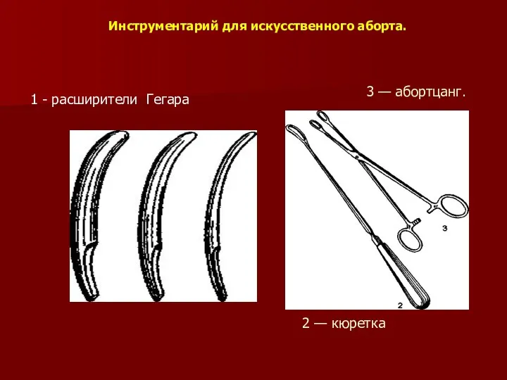 Инструментарий для искусственного аборта. 1 - расширители Гегара 2 — кюретка 3 — абортцанг.