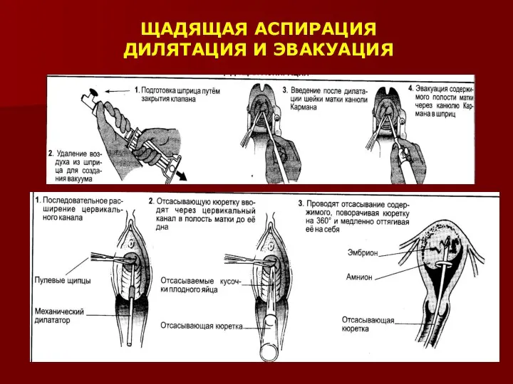 ЩАДЯЩАЯ АСПИРАЦИЯ ДИЛЯТАЦИЯ И ЭВАКУАЦИЯ