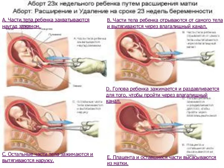 А. Части тела ребенка захватываются наугад зажимом. В. Части тела