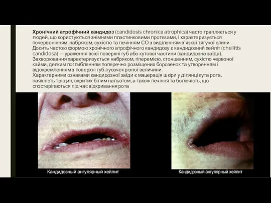 Хронічний атрофічний кандидоз (candidosis chronica atrophica) часто трапляється у людей, що користуються знімними