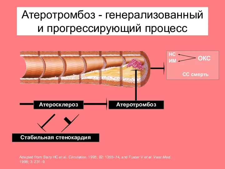 Атеротромбоз - генерализованный и прогрессирующий процесс НС ИМ СС смерть