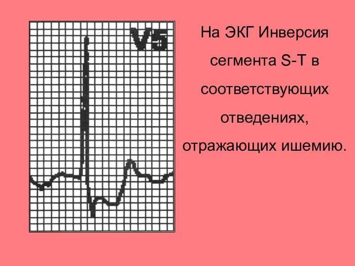 На ЭКГ Инверсия сегмента S-Т в соответствующих отведениях, отражающих ишемию.