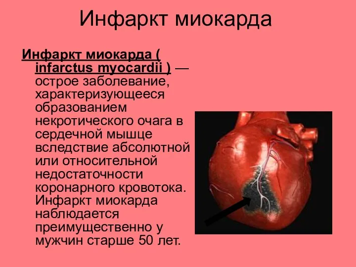 Инфаркт миокарда Инфаркт миокарда ( infarctus myocardii ) — острое