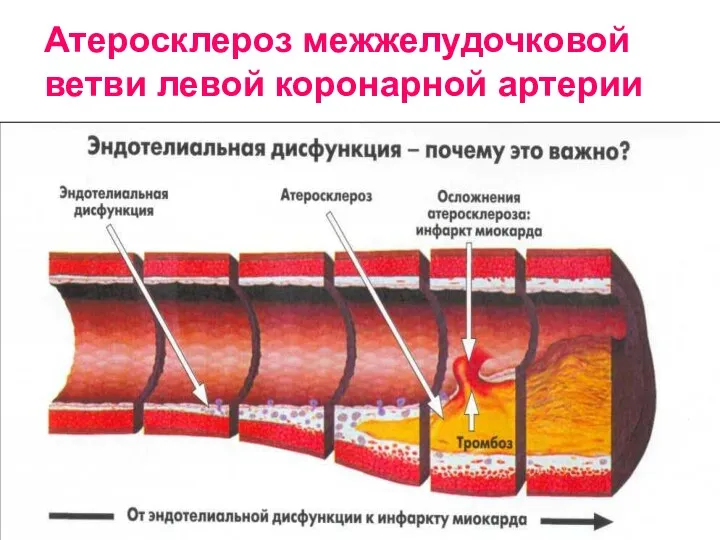 Атеросклероз межжелудочковой ветви левой коронарной артерии
