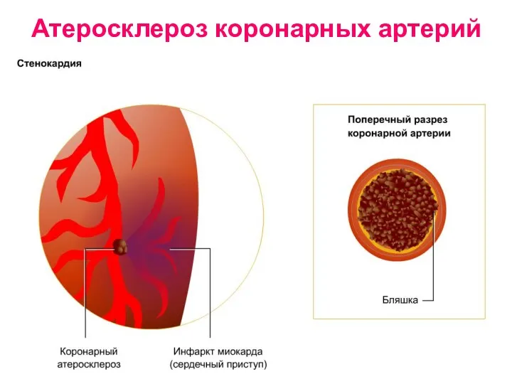 Атеросклероз коронарных артерий