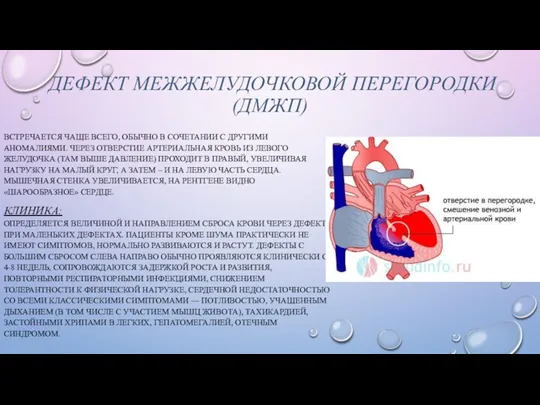 ДЕФЕКТ МЕЖЖЕЛУДОЧКОВОЙ ПЕРЕГОРОДКИ (ДМЖП) ВСТРЕЧАЕТСЯ ЧАЩЕ ВСЕГО, ОБЫЧНО В СОЧЕТАНИИ