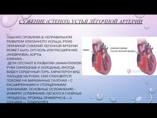 СУЖЕНИЕ (СТЕНОЗ) УСТЬЯ ЛЁГОЧНОЙ АРТЕРИИ ОБЫЧНО ПРОБЛЕМА В НЕПРАВИЛЬНОМ РАЗВИТИИ