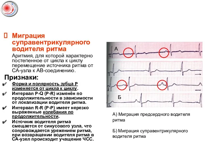 Миграция суправентрикулярного водителя ритма Аритмия, для которой характерно постепенное от