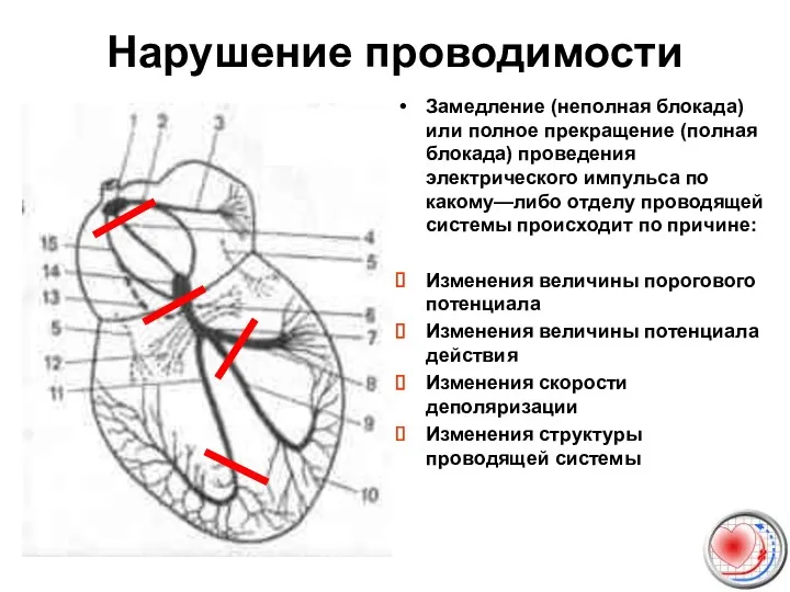 Нарушение проводимости Замедление (неполная блокада) или полное прекращение (полная блокада)