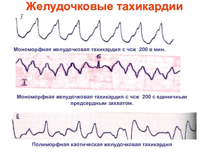 Желудочковые тахикардии Мономорфная желудочковая тахикардия с чсж 200 в мин.