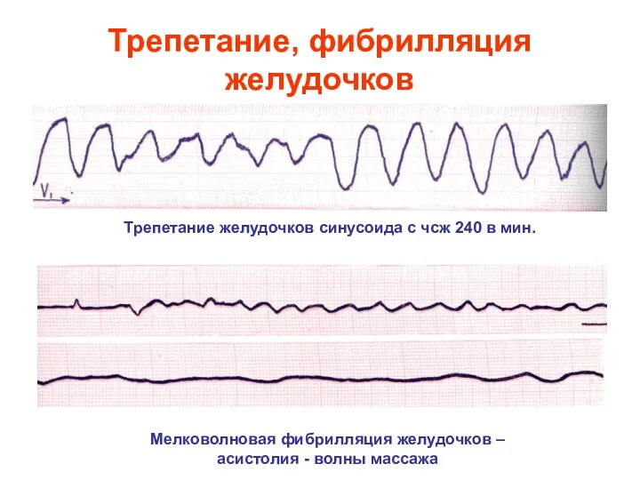 Трепетание, фибрилляция желудочков Мелковолновая фибрилляция желудочков – асистолия - волны