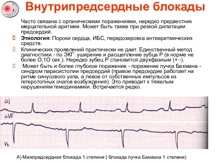 Внутрипредсердные блокады Часто связана с органическими поражениями, нередко предвестник мерцательной