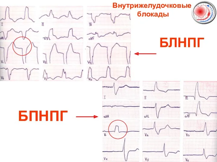 БЛНПГ БПНПГ Внутрижелудочковые блокады