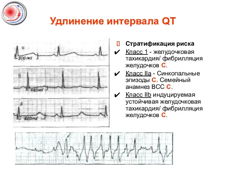 Удлинение интервала QT Стратификация риска Класс 1 - желудочковая тахикардия/