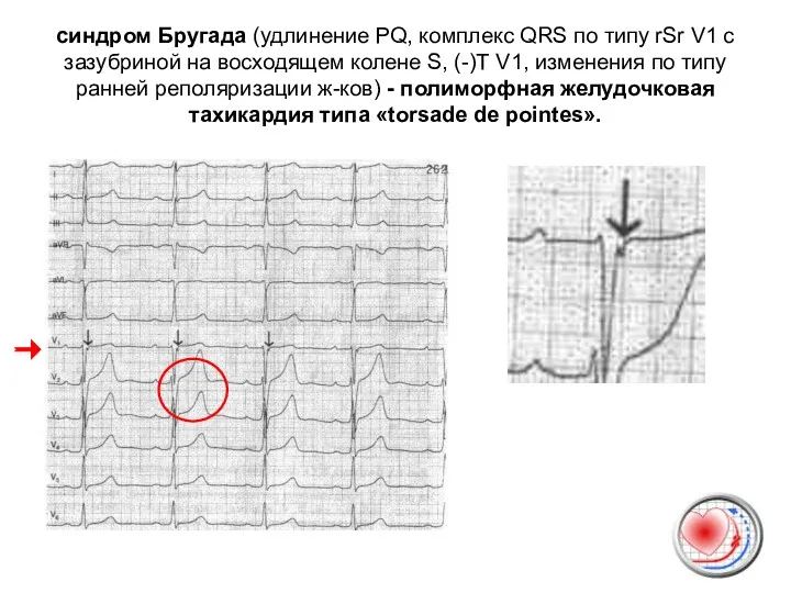 синдром Бругада (удлинение PQ, комплекс QRS по типу rSr V1