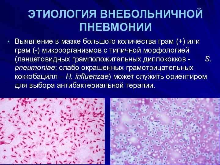 ЭТИОЛОГИЯ ВНЕБОЛЬНИЧНОЙ ПНЕВМОНИИ Выявление в мазке большого количества грам (+)