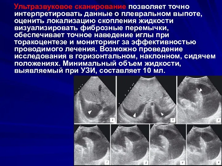 Ультразвуковое сканирование позволяет точно интерпретировать данные о плевральном выпоте, оценить