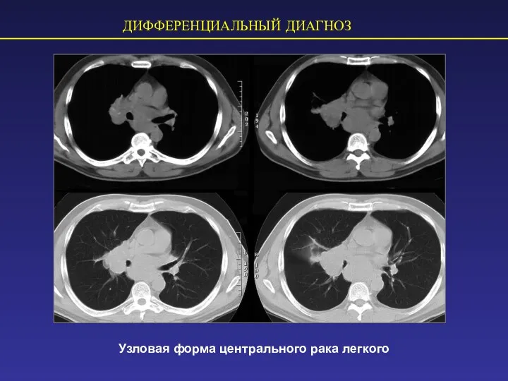 ДИФФЕРЕНЦИАЛЬНЫЙ ДИАГНОЗ Узловая форма центрального рака легкого