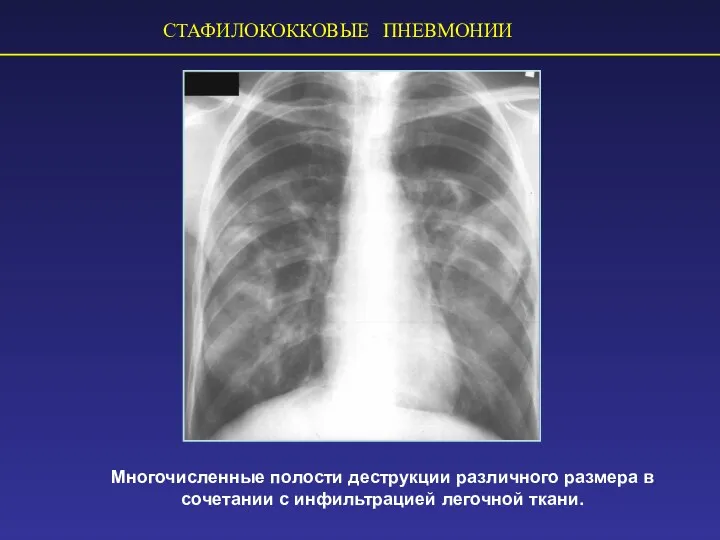 СТАФИЛОКОККОВЫЕ ПНЕВМОНИИ Многочисленные полости деструкции различного размера в сочетании с инфильтрацией легочной ткани.