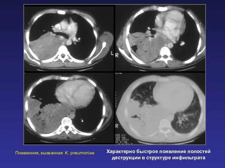 Характерно быстрое появление полостей деструкции в структуре инфильтрата Пневмония, вызванная K. pneumoniae