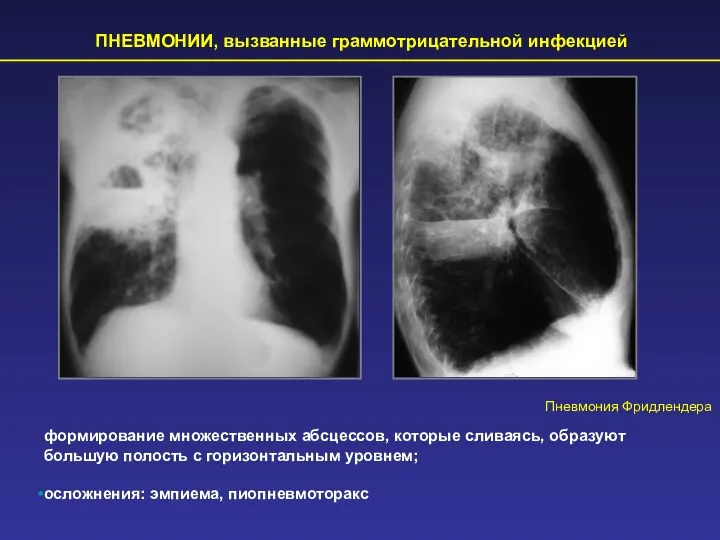 ПНЕВМОНИИ, вызванные граммотрицательной инфекцией Пневмония Фридлендера формирование множественных абсцессов, которые