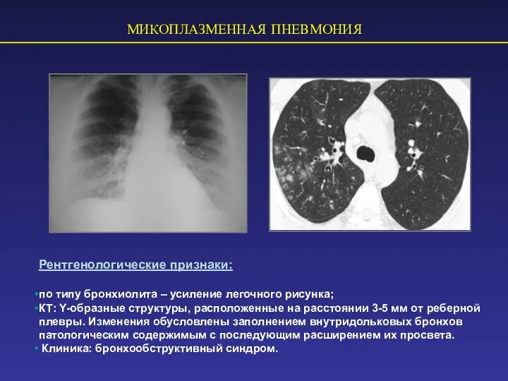 МИКОПЛАЗМЕННАЯ ПНЕВМОНИЯ Рентгенологические признаки: по типу бронхиолита – усиление легочного