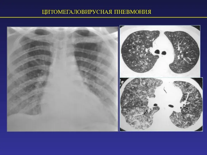 ЦИТОМЕГАЛОВИРУСНАЯ ПНЕВМОНИЯ