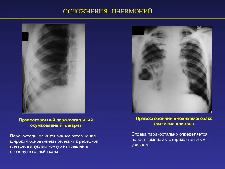 ОСЛОЖНЕНИЯ ПНЕВМОНИЙ Правосторонний паракостальный осумкованный плеврит Паракостальное интенсивное затемнение широким