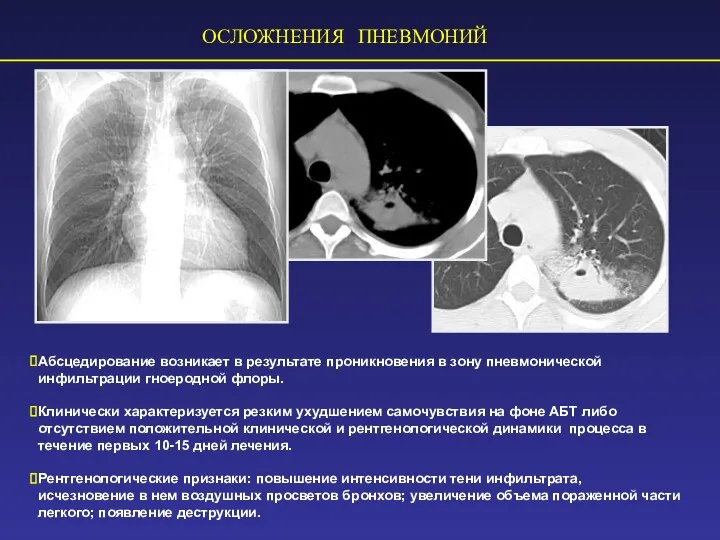 ОСЛОЖНЕНИЯ ПНЕВМОНИЙ Абсцедирование возникает в результате проникновения в зону пневмонической