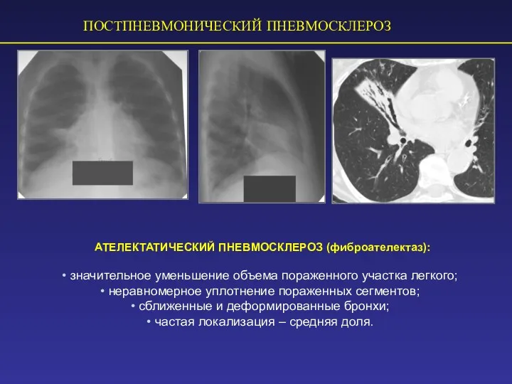 ПОСТПНЕВМОНИЧЕСКИЙ ПНЕВМОСКЛЕРОЗ АТЕЛЕКТАТИЧЕСКИЙ ПНЕВМОСКЛЕРОЗ (фиброателектаз): значительное уменьшение объема пораженного участка